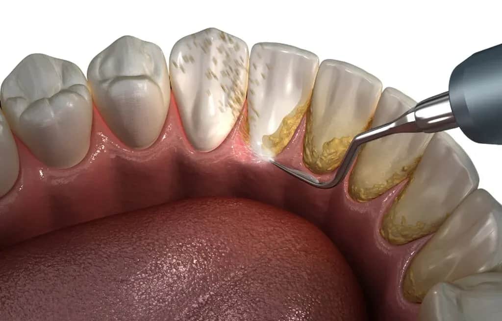 Skuteczne sposoby na złagodzenie bólu dziąseł w ciąży