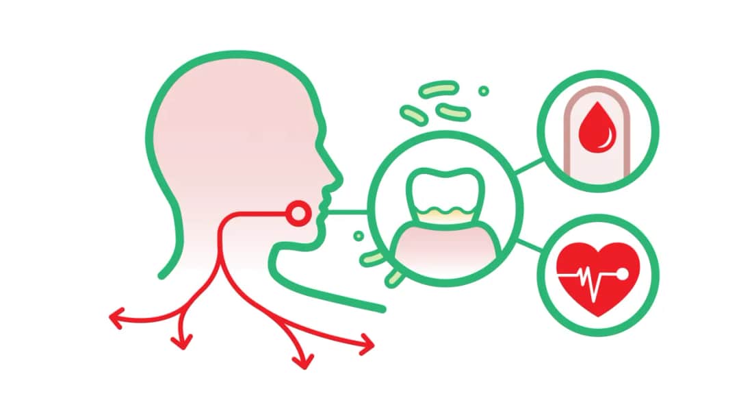 Zapalenie dziąseł od czego? Poznaj przyczyny i jak ich unikać