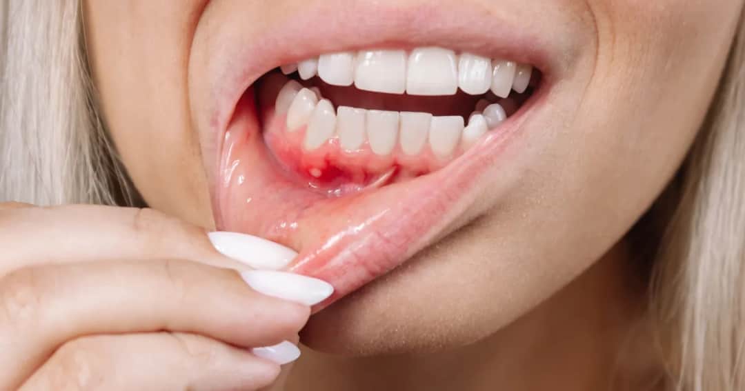 Rak dziąseł jak wygląda – zdjęcia objawów, które musisz znać