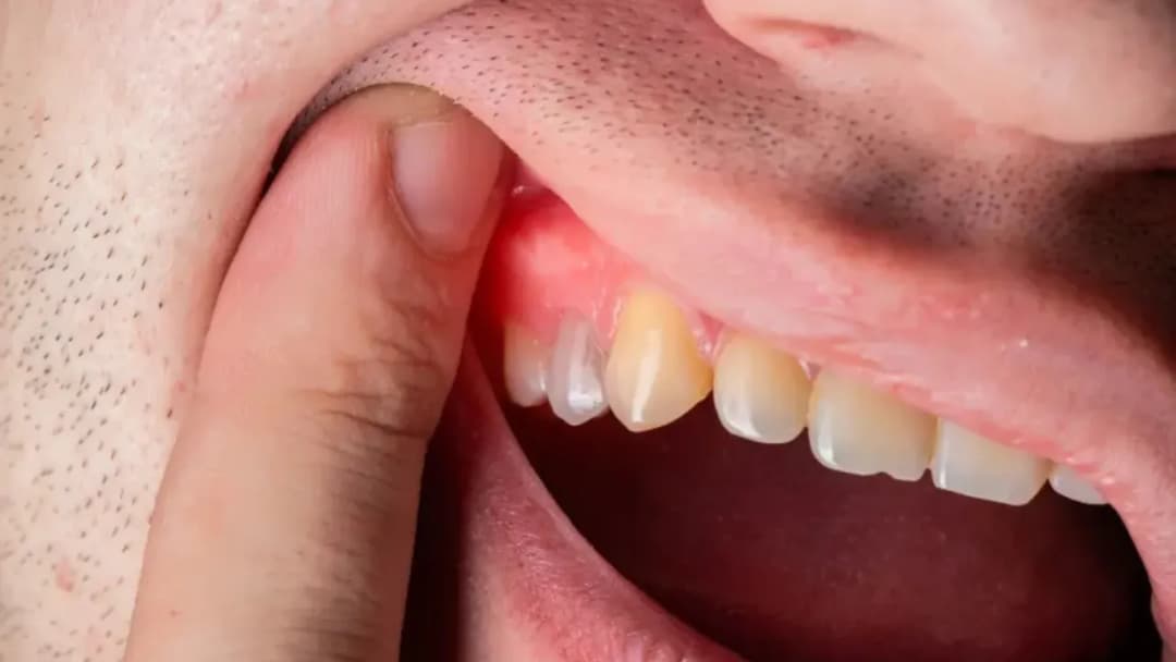 Jak skutecznie wyciągnąć ropę z zęba i uniknąć bólu?