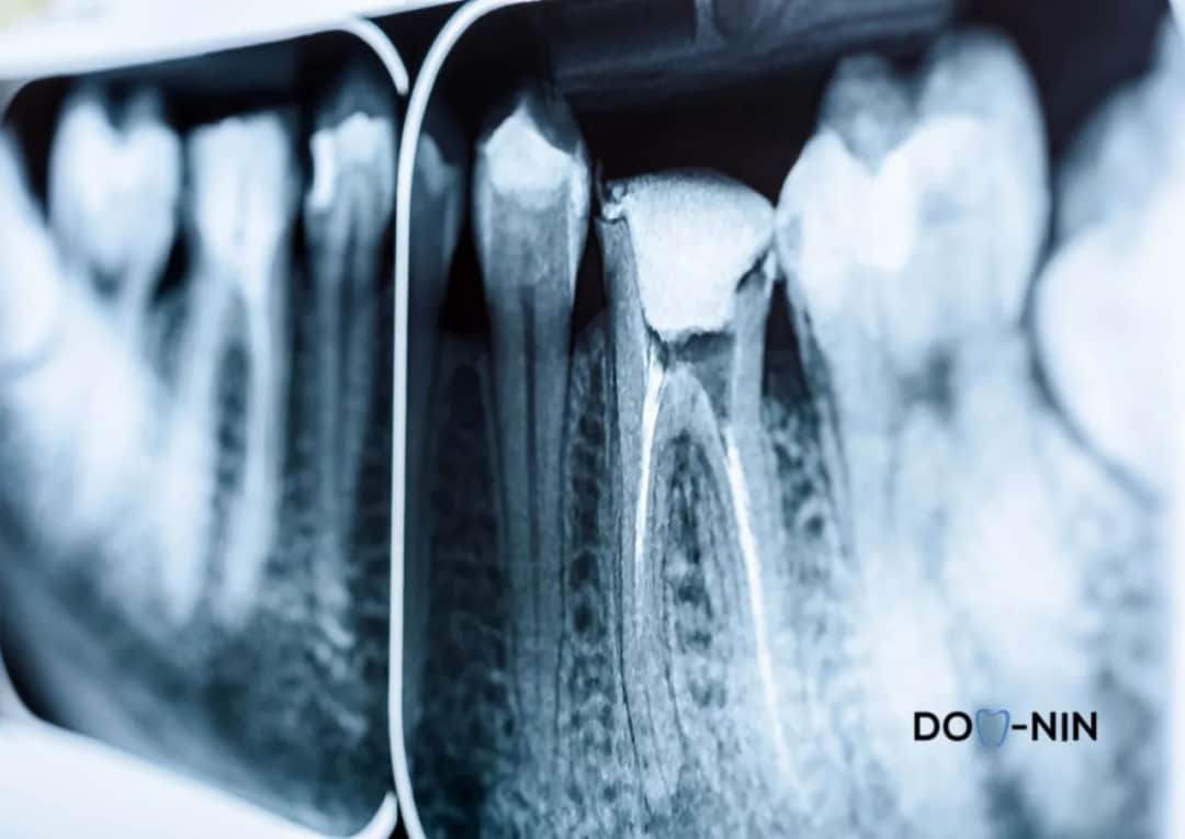 Czy torbiel zęba to nowotwór? Poznaj zagrożenia i objawy
