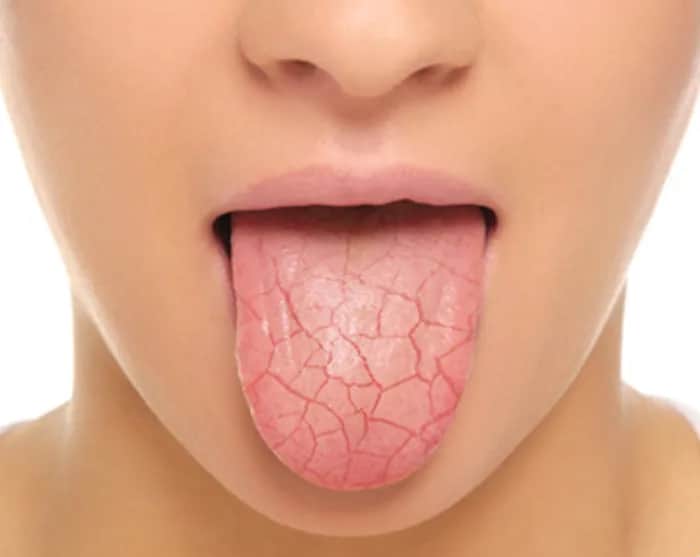 Suchość w jamie ustnej w nocy objawy i przyczyny, które musisz znać